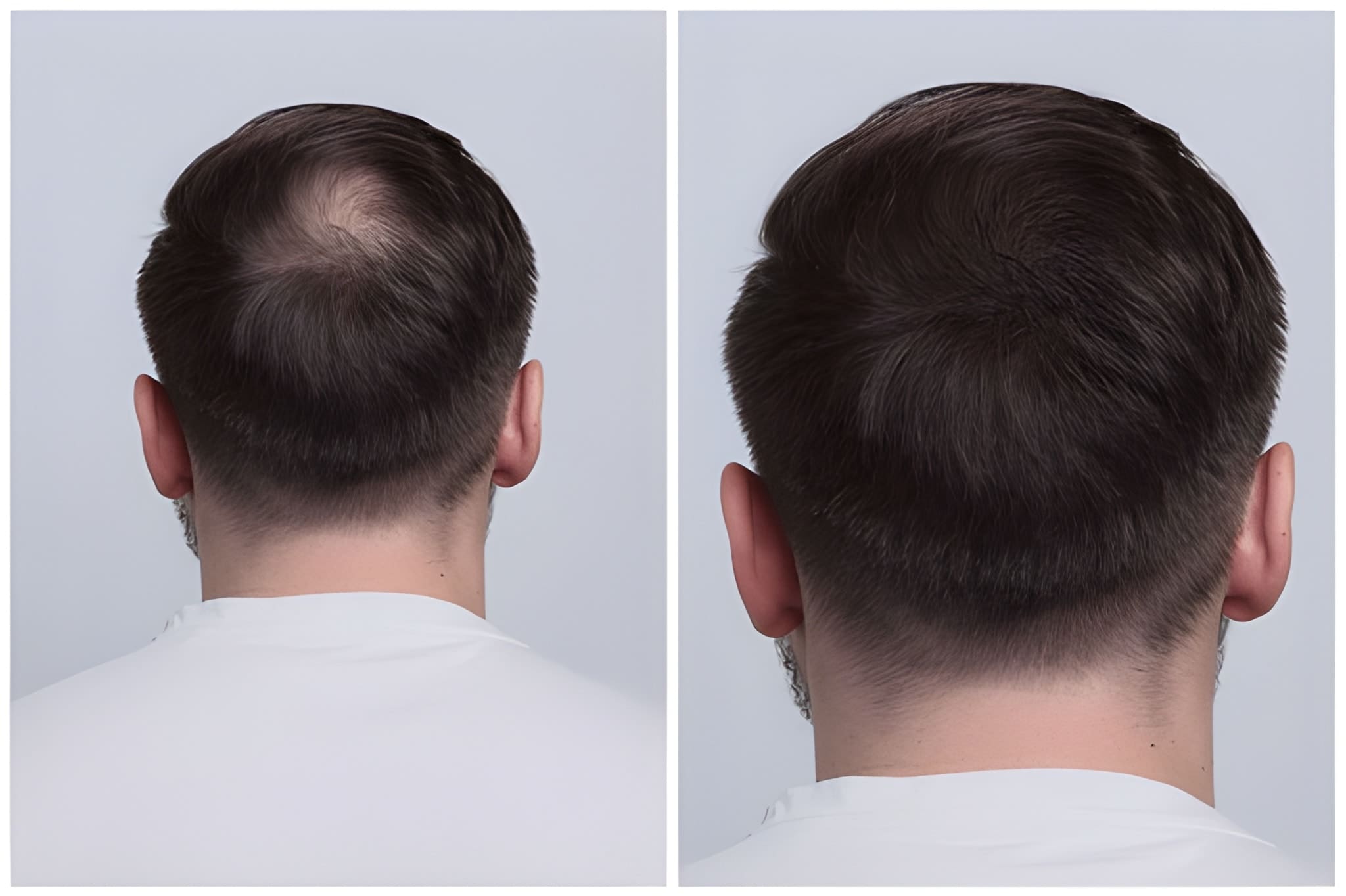Hair Transplant