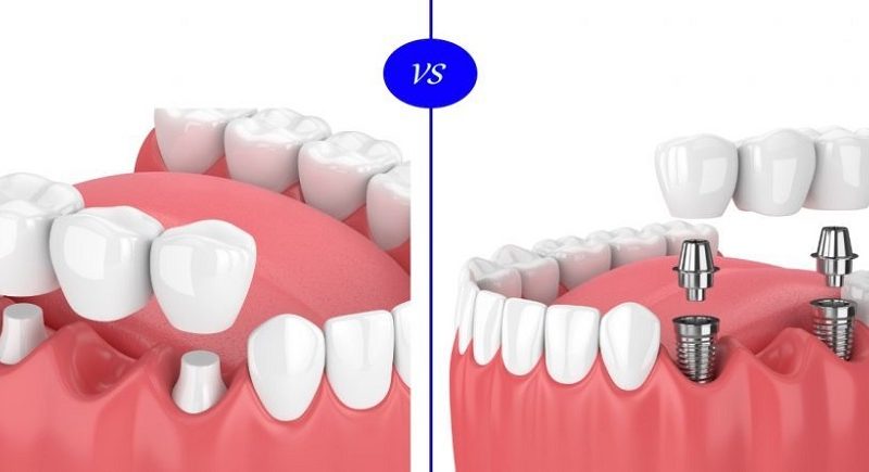 Dental Bridge and Dental Implant
