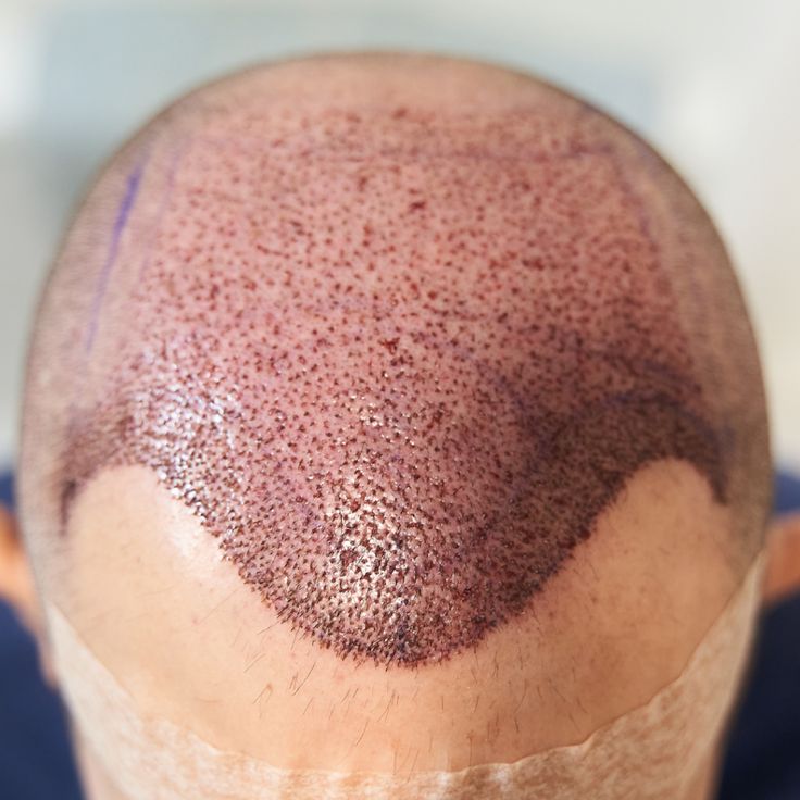 Stop Crown Balding: Uncover the Causes & Proven Prevention Strategies