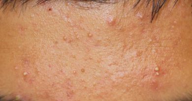 Inflammatory Acne