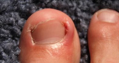 Podiatrist ingrown toenail Houston