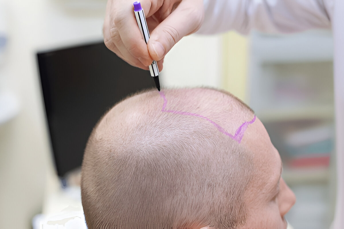 What Happens During Hair Transplant Surgery? – TIME BUSINESS NEWS