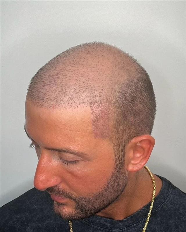 Is Hair Transplant Suitable for Thin Hair?