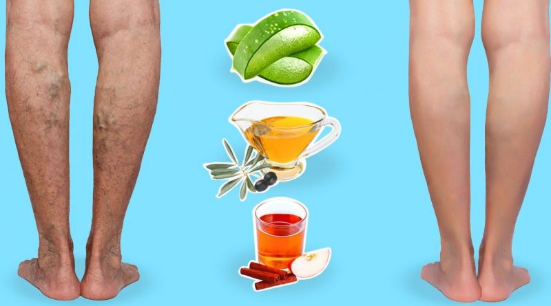Natural Ways To Cure Varicose Veins