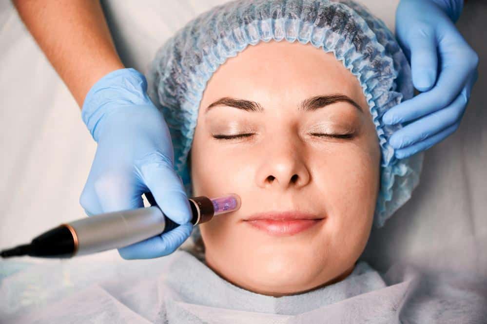 skinpen-microneedling