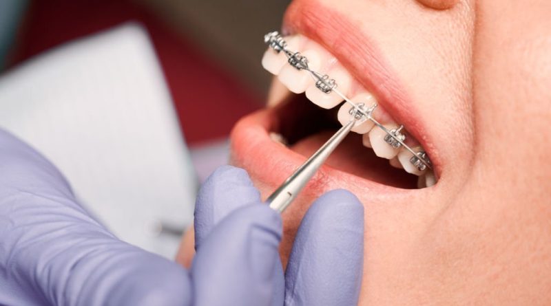 Advantages And Disadvantages Of Fixed Orthodontic