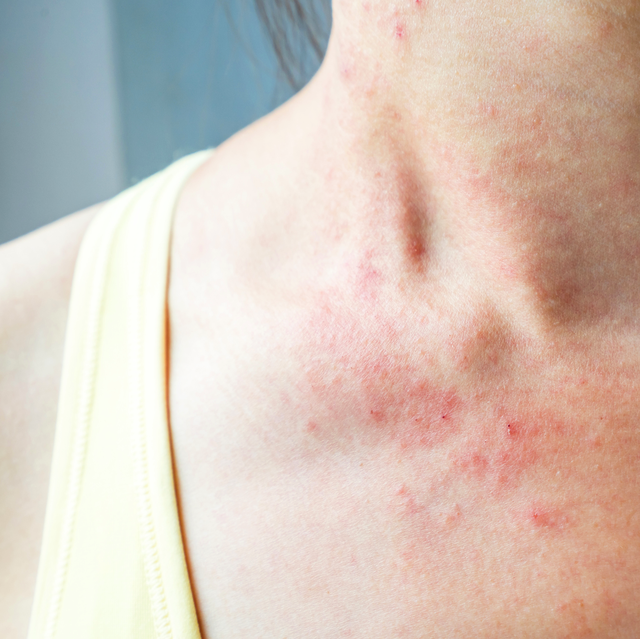 Allergy - Carpet Cleaning Springfield