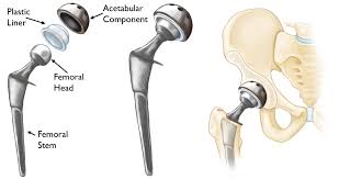 Artificial Hip Replacement Cost