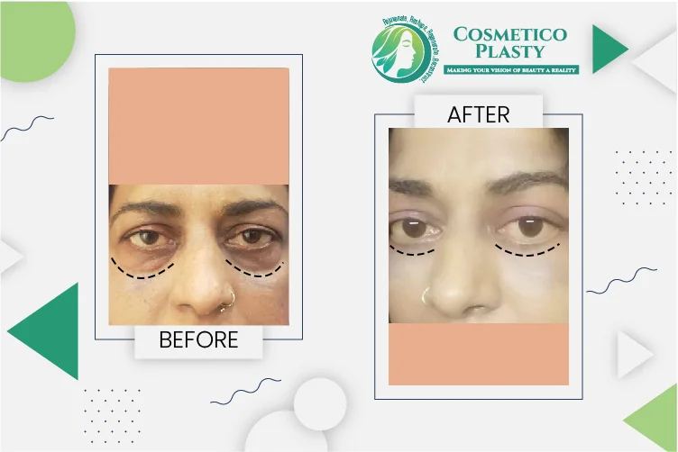 Top Clinics for Eyelid Surgery in Lahore | Patient Guide