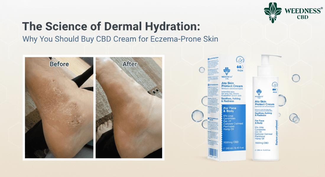 Buy CBD Cream for eczema-prone skin