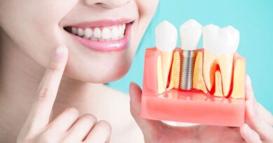 Dental implants abroad