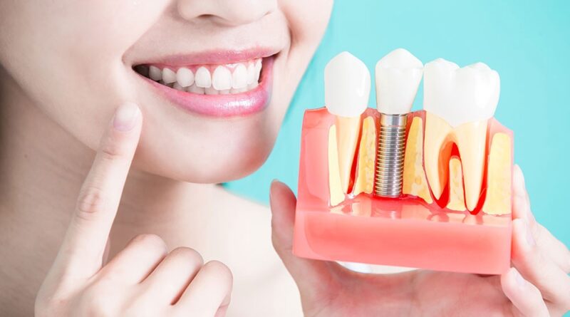 Dental implants abroad