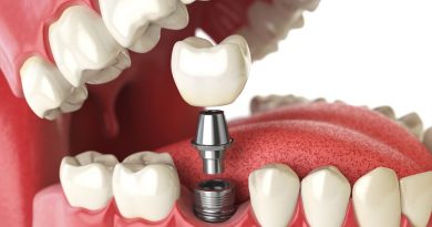 Procedure Of Dental Implants