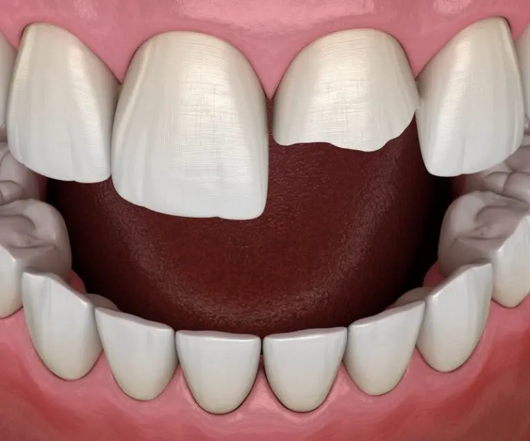 dental bonding in Boynton Beach FL