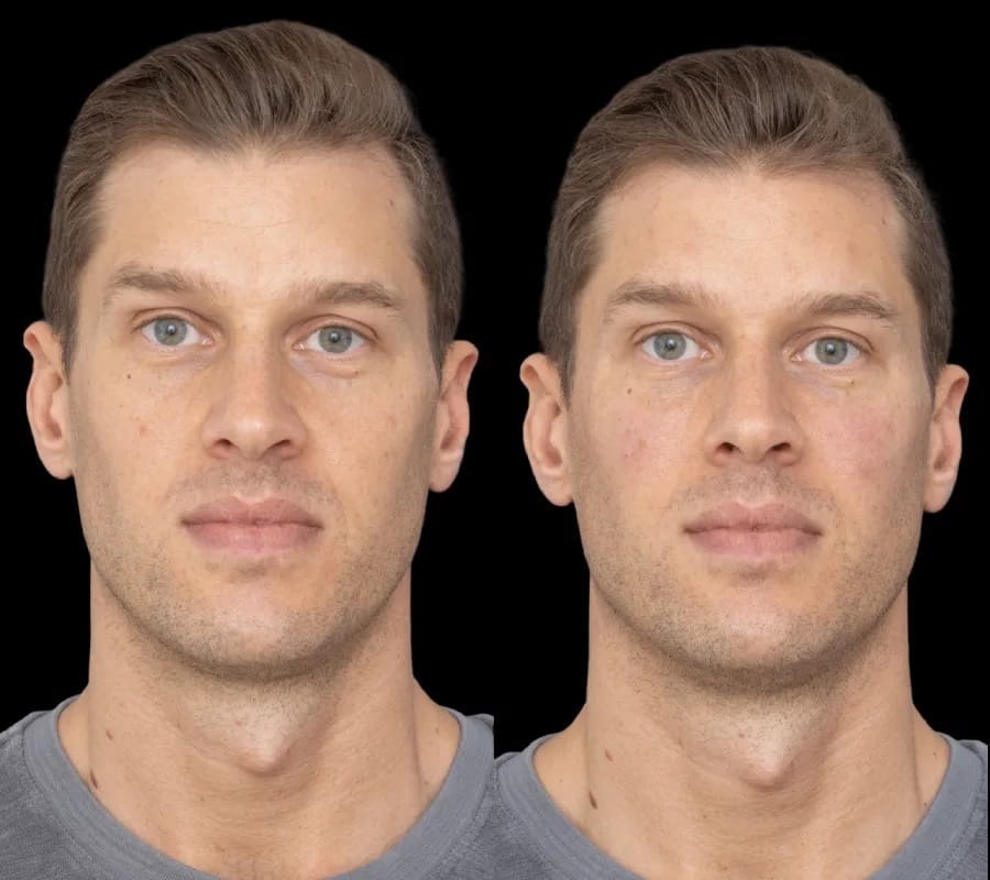 under eye fillers in dubai