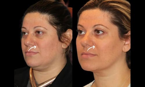 sculptra fillers in dubai