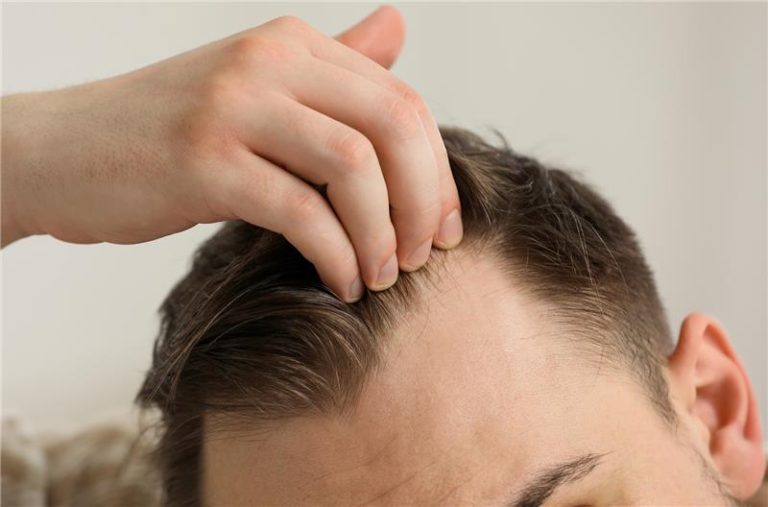 How Effective Is Hair Transplant for Receding Hairlines