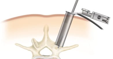 Invasive Spine Surgery