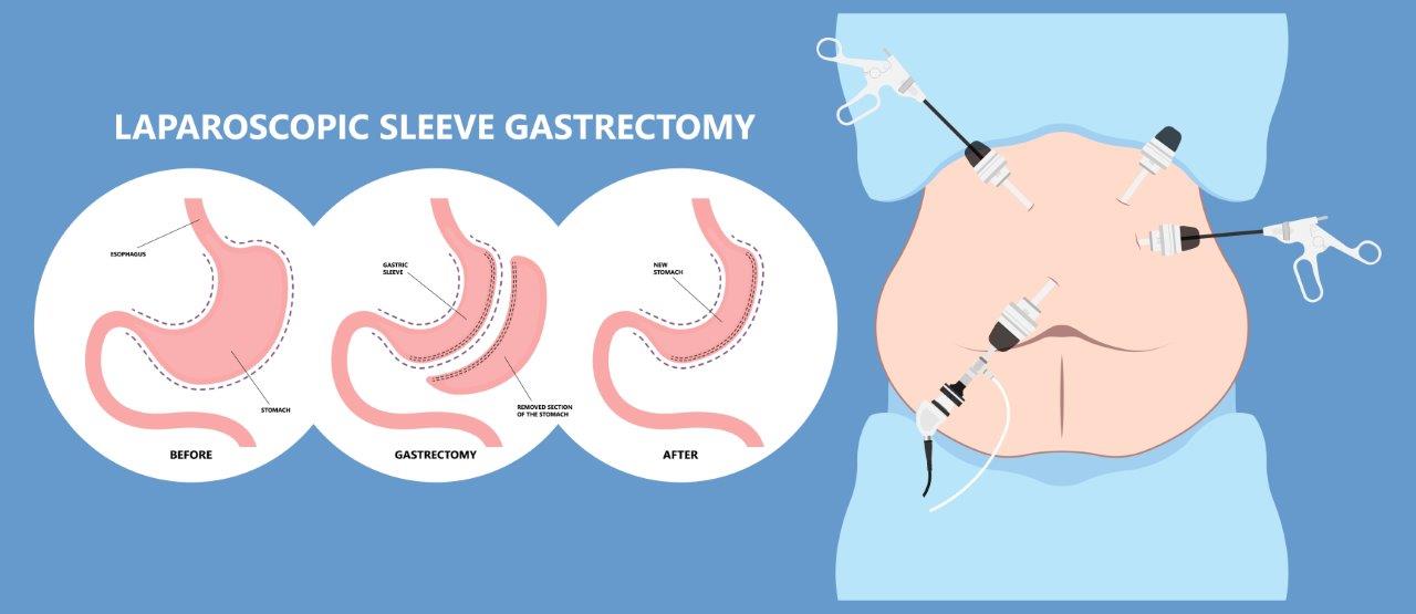 The Sleeve Solution: Eliminating Obesity and Its Chronic Complications
