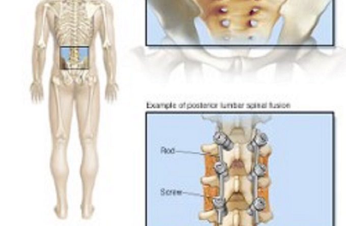 Lumbar spine surgery