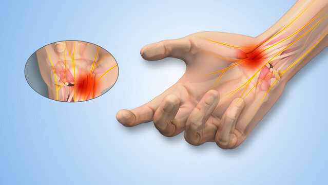 Can Nerve Supplements Improve Tingling and Numbness?