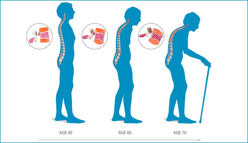 What is Osteoporosis? Symptoms, Causes, and Treatment – TIME BUSINESS NEWS