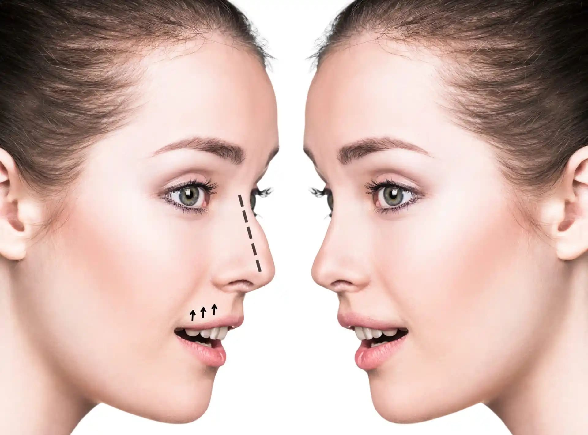 Rhinoplasty in Dubai