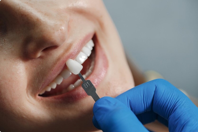 All-On-4 Dental Implants: The Definitive Blueprint for a Stunning Smile