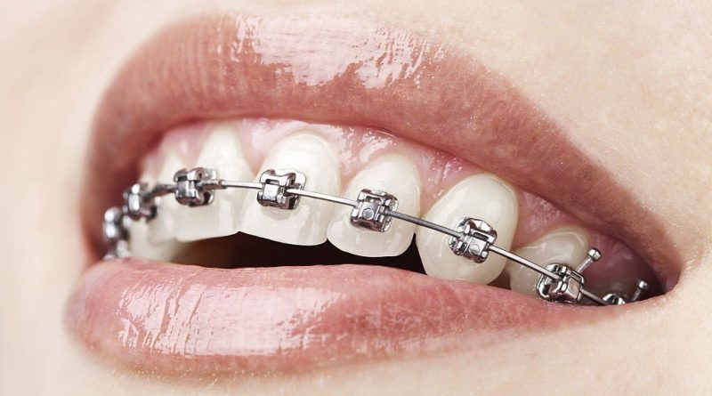 Step-By-Step Process Of How Braces Work