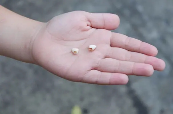 Tartar Breaking Off Teeth Causes and What to Do