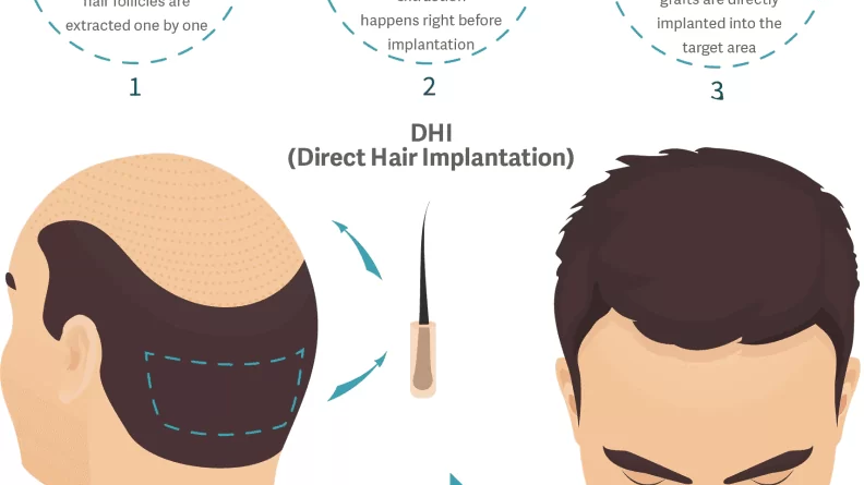 The Main Facts You Need To Know About Hair Transplanting