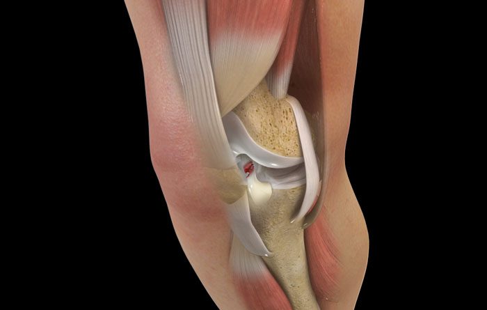 Untreated ACL tears can lead to early-adult arthritis, suggest studies
