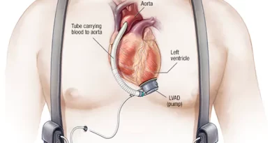 Ventricle Assist Device Market