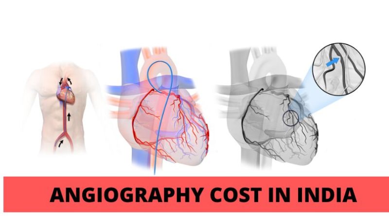 angiography cost in india
