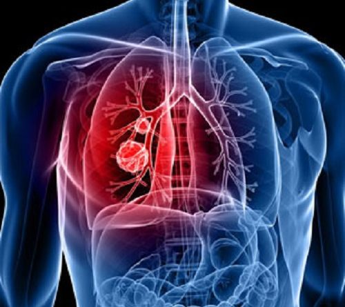lung cancer doctor in Jaipur