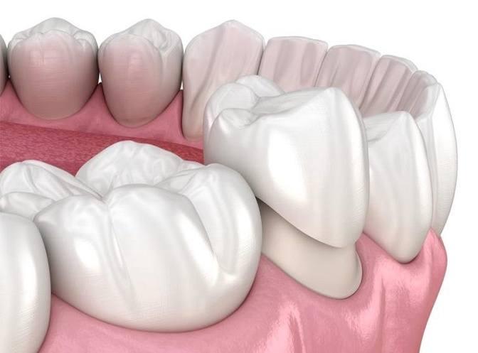 dental crown procedure