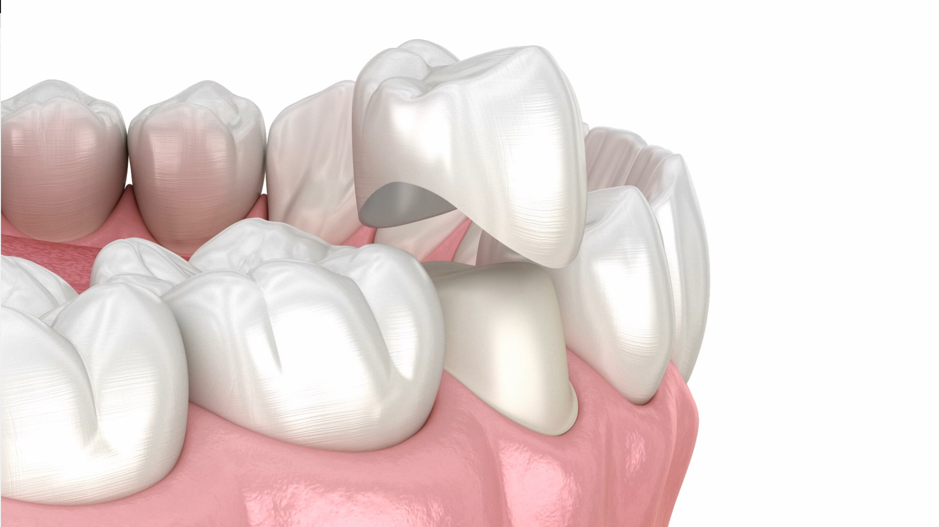 Revitalize Your Smile: Top-Quality Crowns in Boynton Beach, FL – Fancy Smiles
