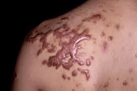 Keloids