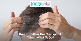 Can Dandruff Affect the Growth of My Transplanted Hair