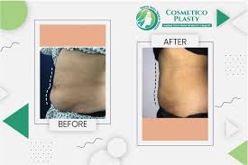 Liposuction in Lahore – What to Expect After Surgery