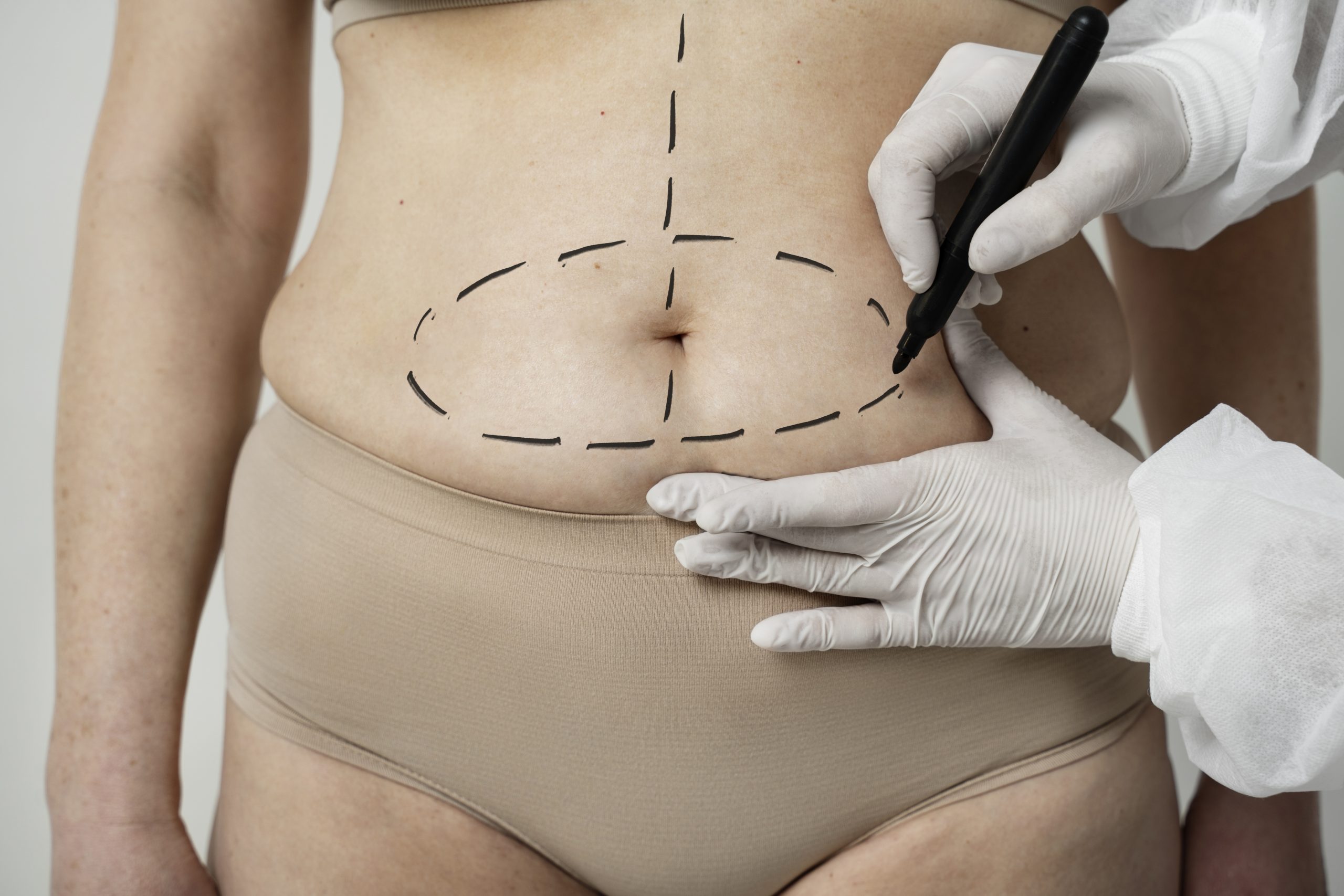 Step-by-Step Guide to Hernia Surgery Recovery