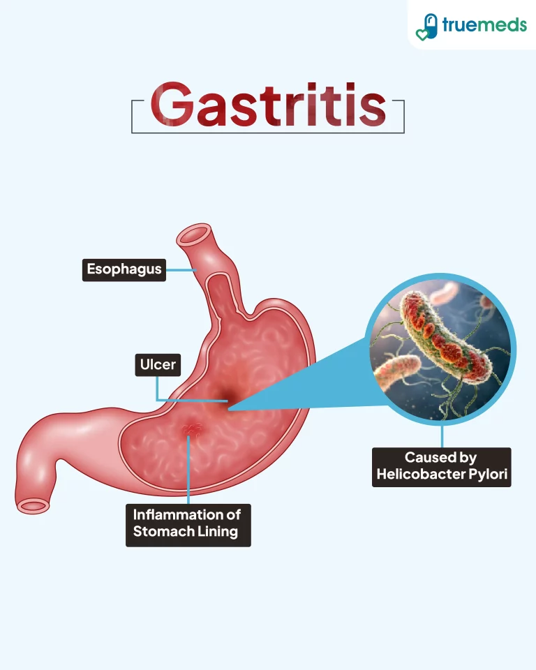Homeopathy Treatment for Gastritis: Doctor-Recommended Guide