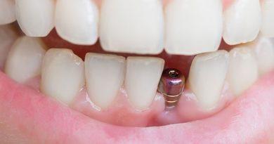 Comprehensive Guide to Affordable Dental Implants in Gilbert
