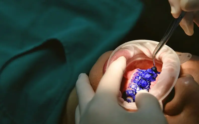 7 Reasons to Choose Guided Biofilm Therapy Over Traditional Cleaning