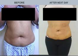 Lahore’s Tummy Tuck: Unveiling Benefits, Recovery Secrets & Top Surgical Experts