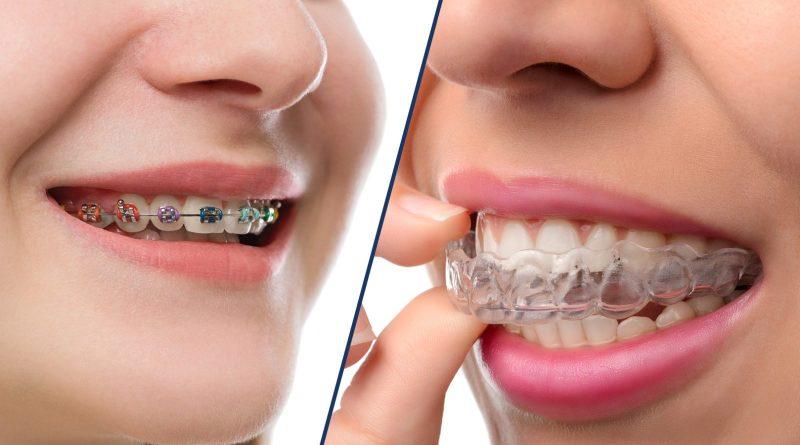 Choosing Invisalign Over Traditional Braces