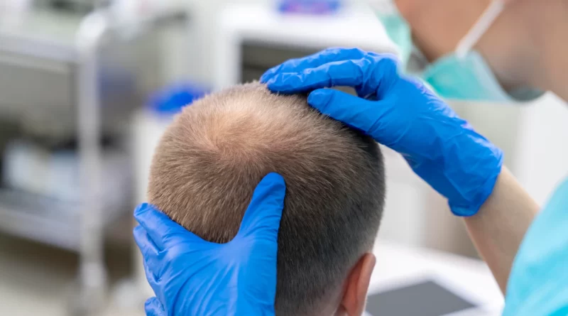 What is the Latest Technology in Hair Transplant?