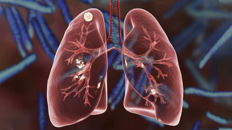 Can Growths in the Lungs Be Non-cancerous