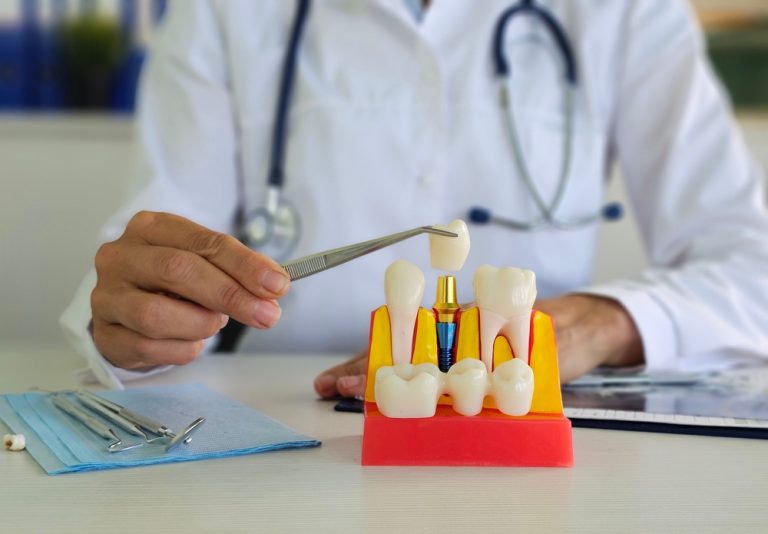 dental bridge vs implant benefits
