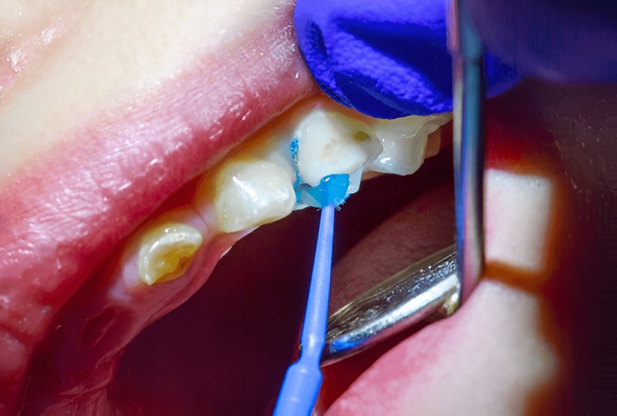 Shielding Smiles: The Secret Weapon of Pediatric Dental Sealants